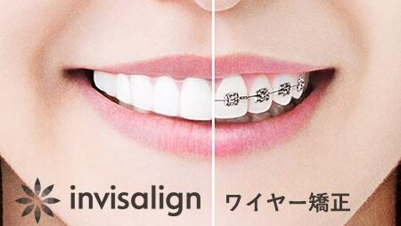 インビザラインとワイヤー矯正