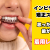 インビザライン矯正
