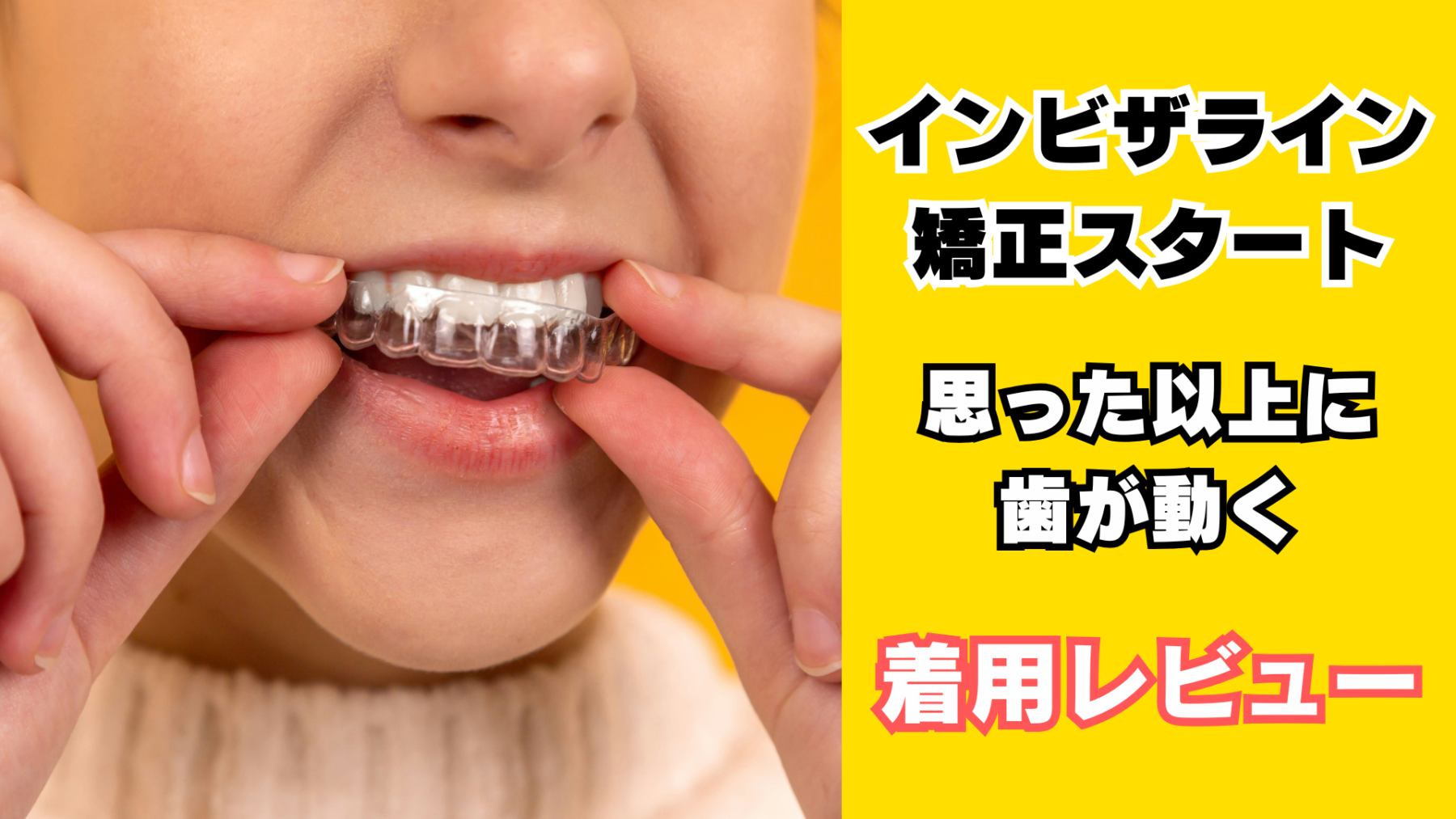 インビザライン矯正