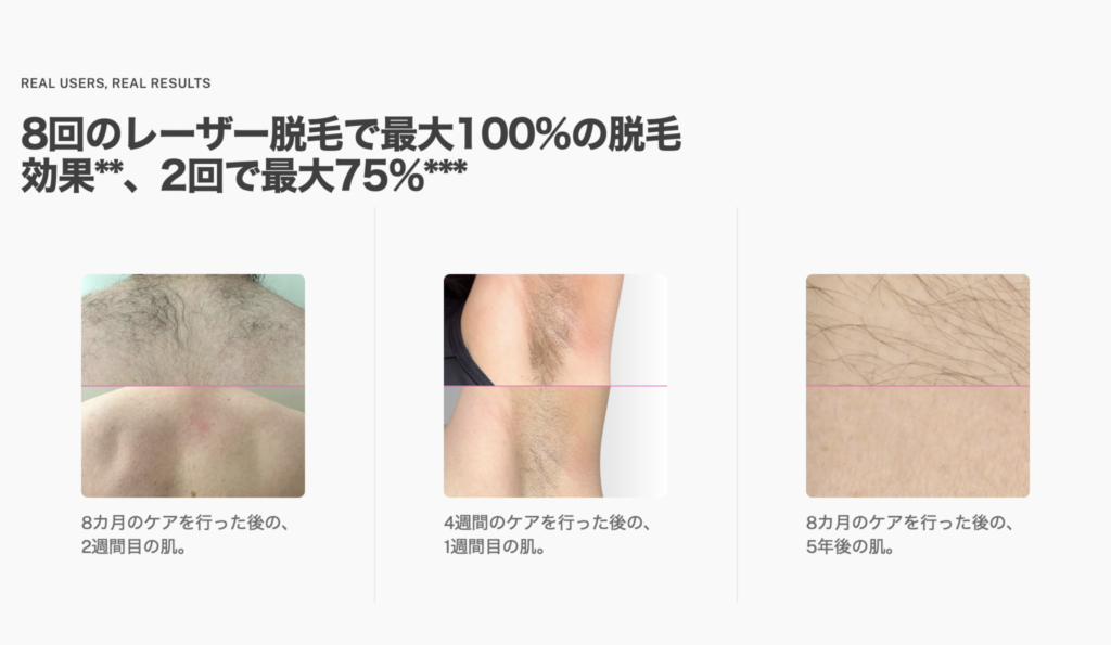 家庭用レーザー脱毛器トリア4X